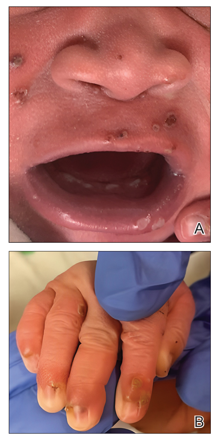The clinical presentation of Langerhans cell histiocytosis in an infant.