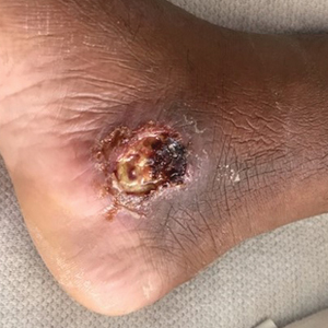 A single, 3-cm, ulcerated and crusted plaque with rolled borders on the right medial ankle.