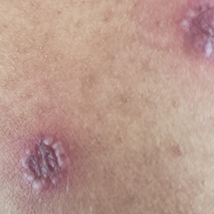 Purpuric plaques on the thigh with peripheral vesiculation.