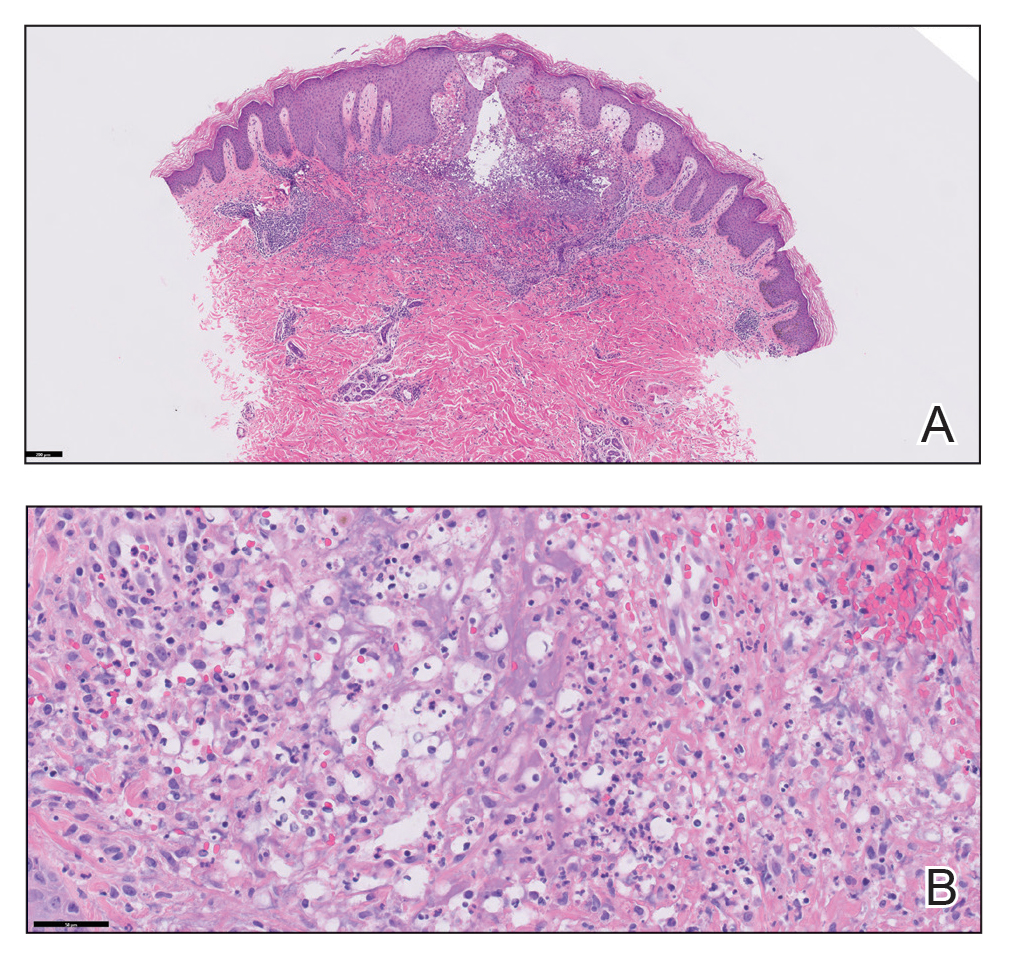 A, Histopathology showed interstitial superficial and mid-dermal neutrophilic dermatitis with focal subepidermal edema (H&E, original magnification ×10). Reference bar indicates 200 μm.