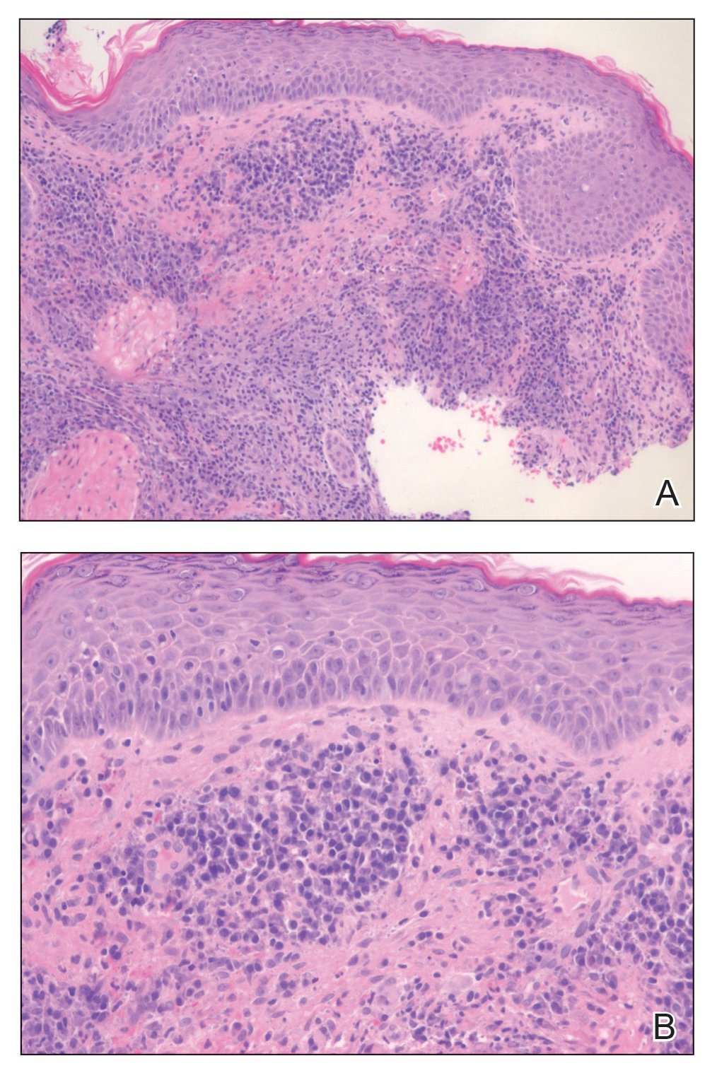 Histopathology revealed patchy plasmalymphocytic infiltrates of the dermis and subcutaneous tissue (H&E, original magnifications ×40 and ×200).