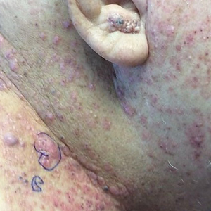 Sharply demarcated, erythematous plaques studded with focally hemorrhagic, angiomatous papules on the neck and upper chest in a patient with cutaneous metastatic salivary duct carcinoma that originated from the parotid gland