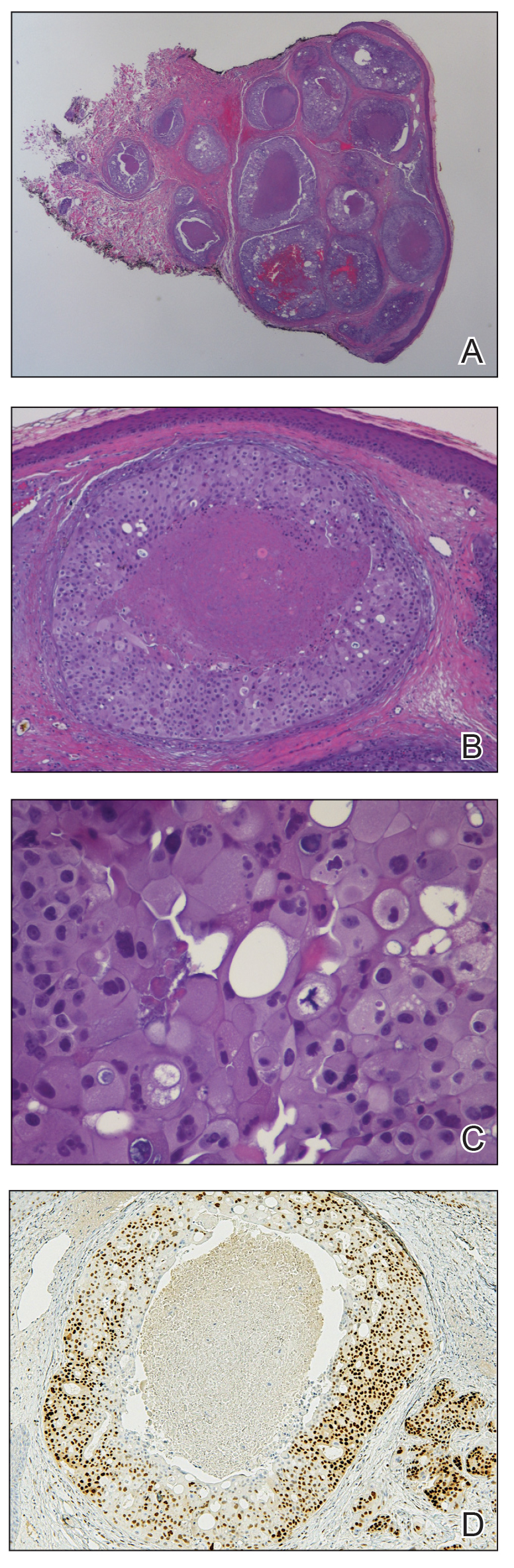 A, Histopathology showed multiple round solid-tumor nodules in the superficial and deep dermis with massive comedo necrosis (H&E, original magnification ×10). B, A tumor nodule with central zone of cellular necrosis (H&E, original magnification ×20). 