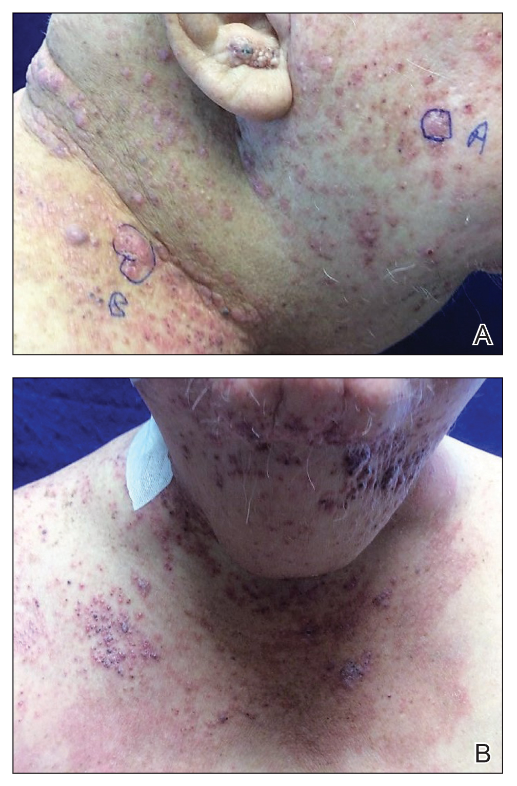 Sharply demarcated, erythematous plaques studded with focally hemorrhagic, angiomatous papules on the neck and upper chest in a patient with cutaneous metastatic salivary duct carcinoma that originated from the parotid gland