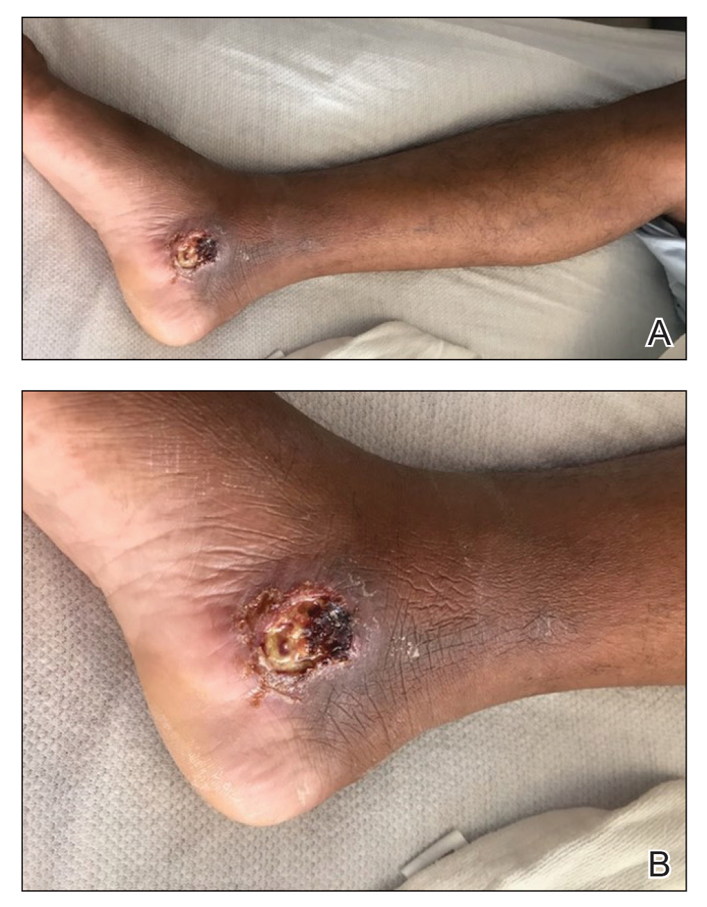 A single, 3-cm, ulcerated and crusted plaque with rolled borders on the right medial ankle.