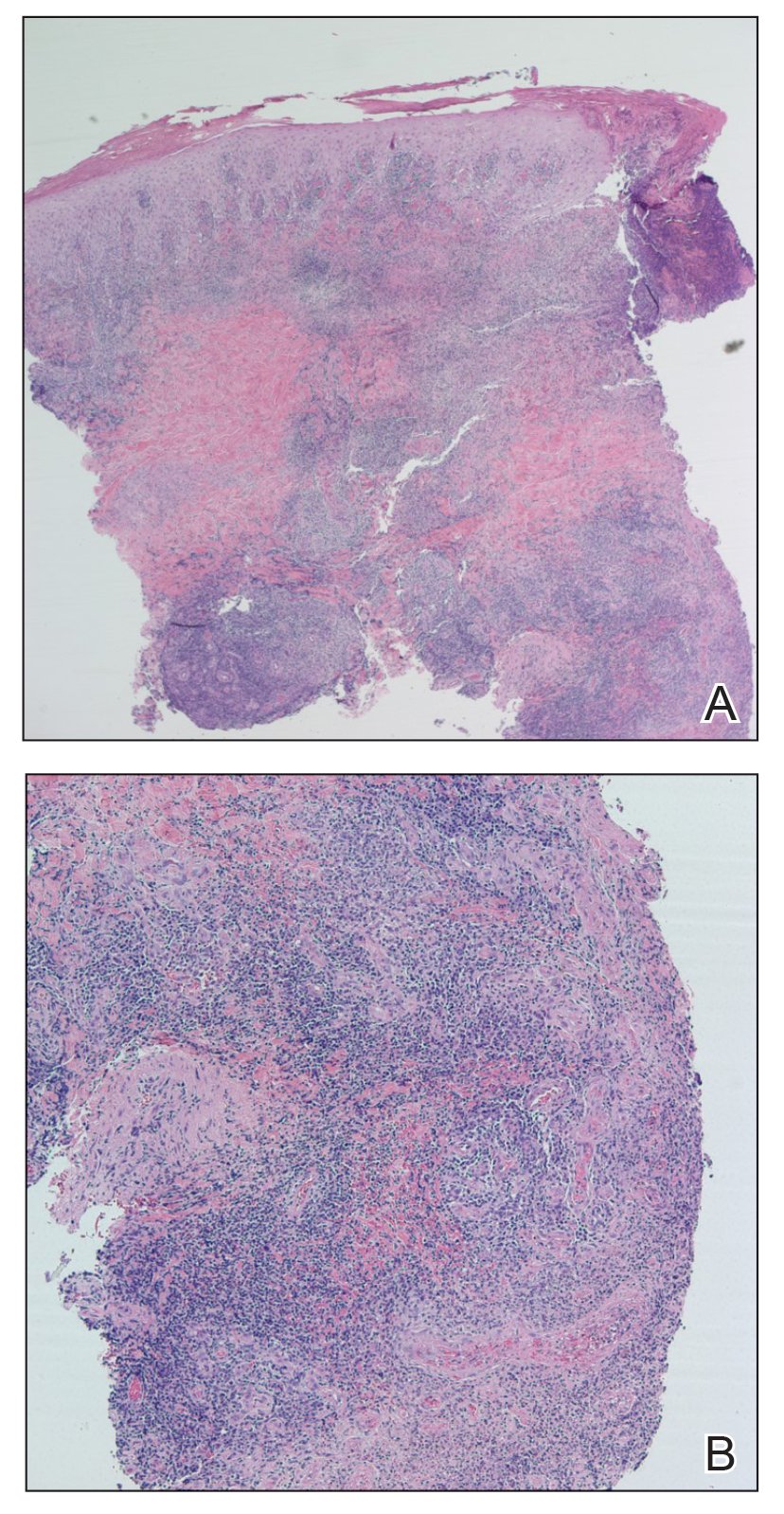 In addition to acute and chronic necrotizing inflammation, numerous histiocytes have a vaguely granulomatous appearance (H&E, original magnifications ×4 and ×10).