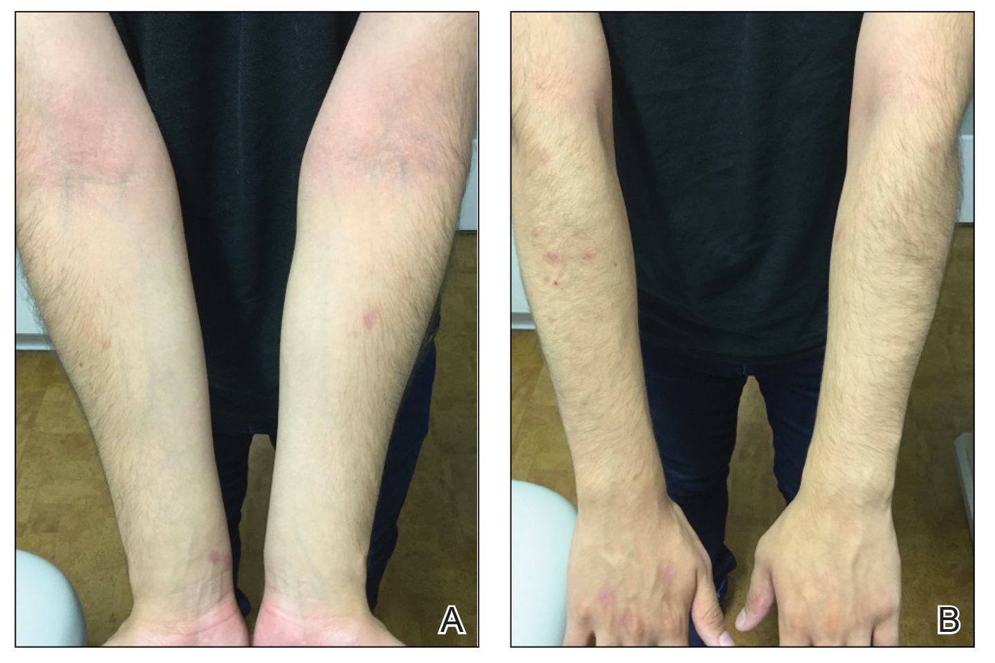 Marked improvement of atopic dermatitis on both antecubital fossae and forearms, respectively, 1 month after dupilumab was started.