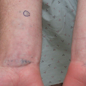 Blue nodules on the forearms in an active-duty military servicemember