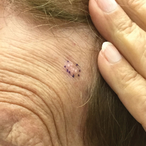 Prior to biopsy, examination revealed an ill-defined, fleshcolored to white, smooth plaque on the left forehead