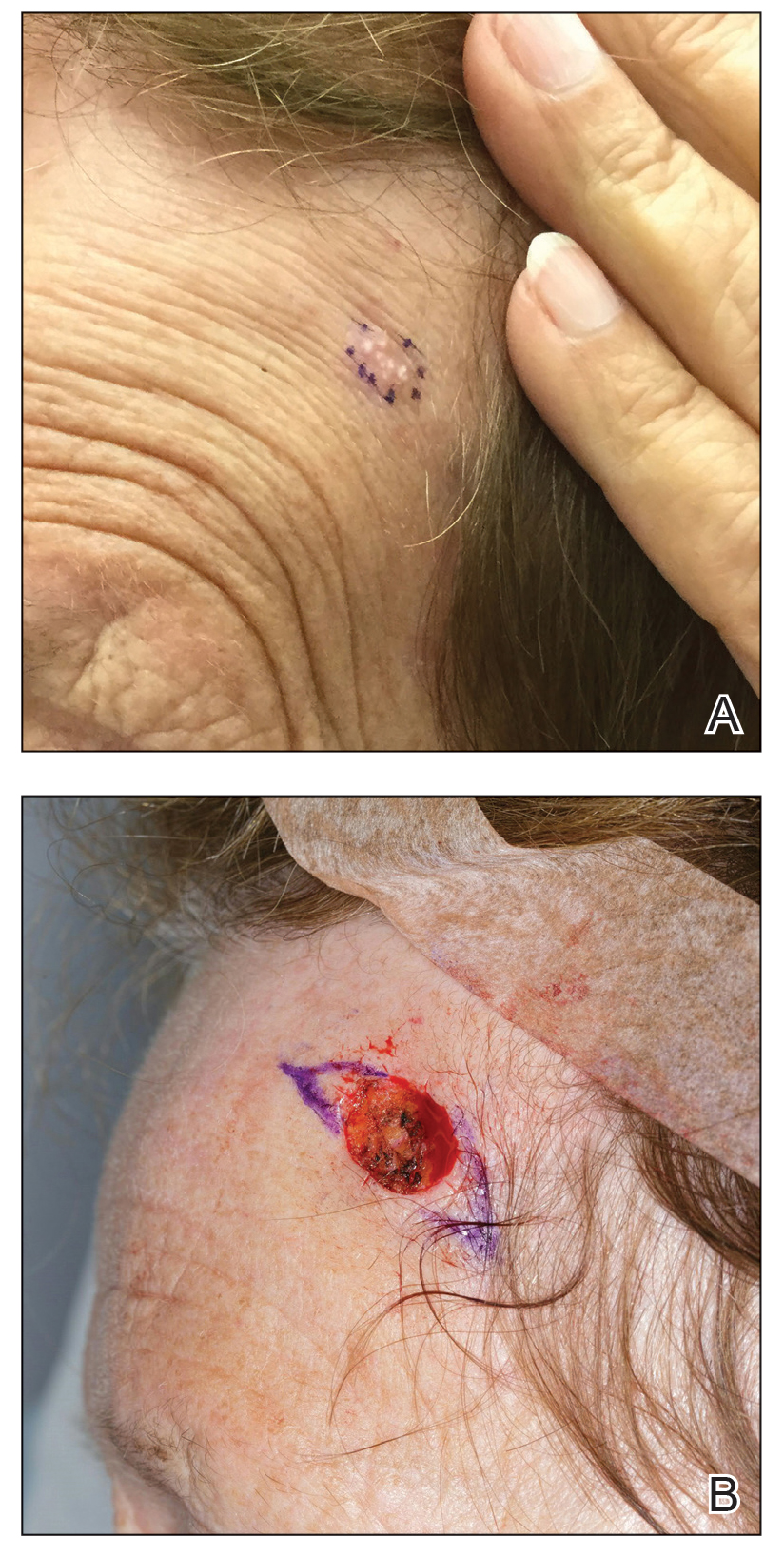 A, Prior to biopsy, examination revealed an ill-defined, fleshcolored to white, smooth plaque on the left forehead. B, After 1 stage of Mohs micrographic surgery with Burow triangles drawn.