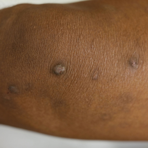 Prurigo nodules on the leg of an Asian patient with atopic dermatitis.