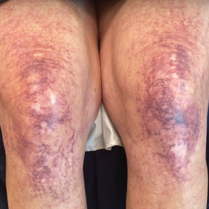 The addition of sclerotherapy to pulsed dye laser therapy showed a decrease in telangiectases and smaller patches after 2 years.