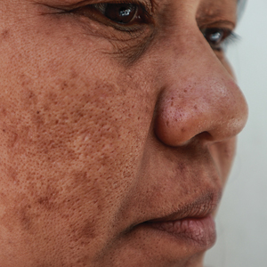 Melasma