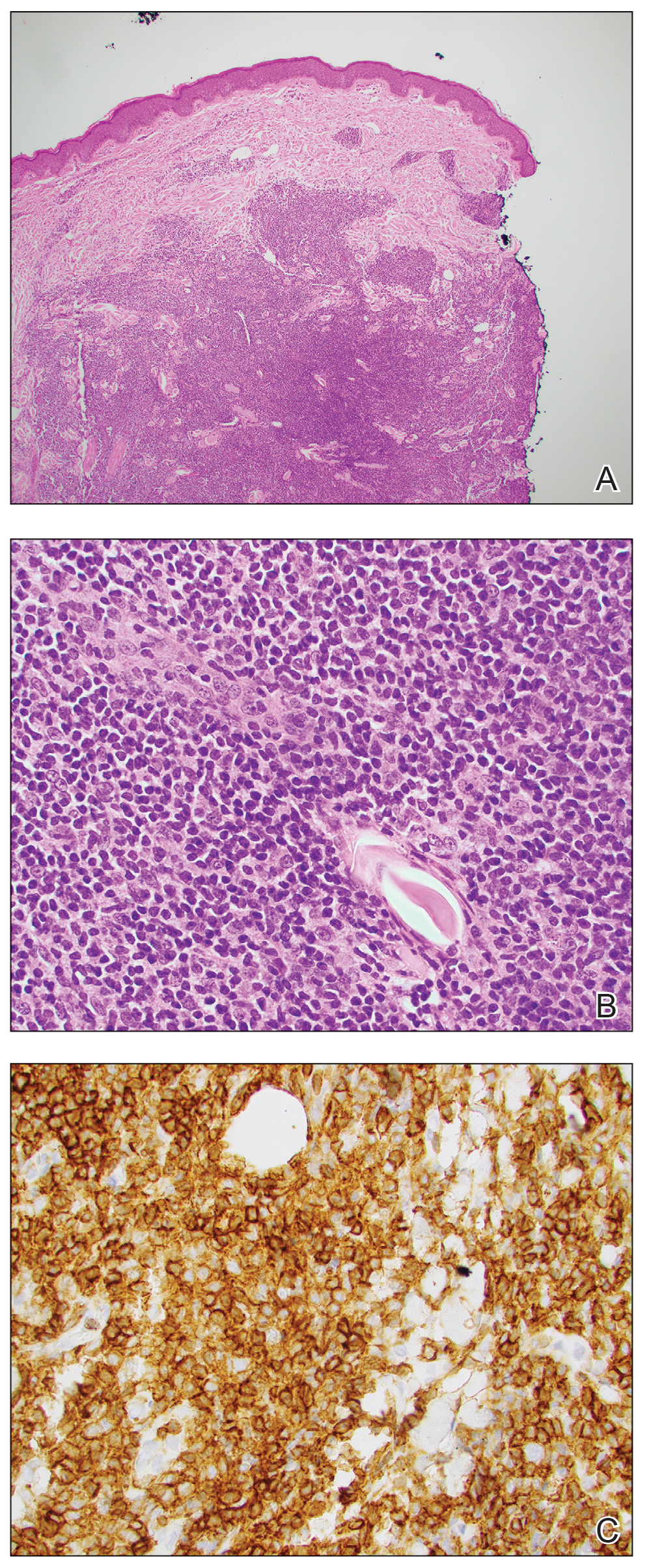 A, Histopathology revealed dense lymphoid infiltrates, predominantly in periadnexal areas, extending into subcutaneous tissue (H&E, original magnification ×20). B, The lymphoid cells predominantly were small with round to irregular nuclei...