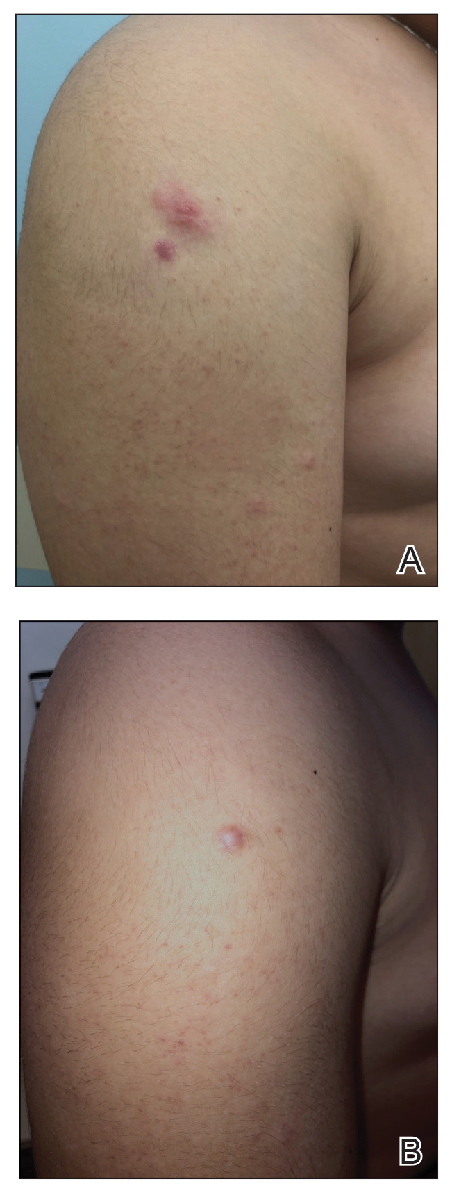  A, Multiple erythematous dermal papules and a scar at a biopsy site on the right arm prior to treatment. B, After treatment with clobetasol ointment 0.05% and oral doxycycline 100 mg, the dermal papules resolved with a residual hypertrophic scar...