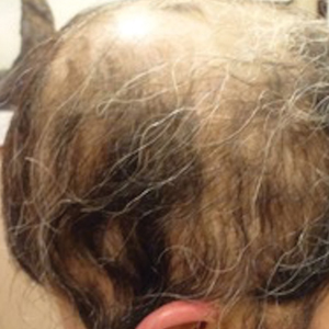 A 29-year-old woman with alopecia universalis that did not respond to 1 year of treatment with intralesional triamcinolone, clobetasol foam, minoxidil foam 5%, and a UVB brush.