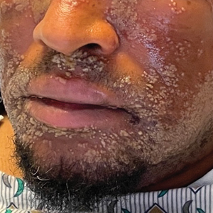 Pustular eruption on the face