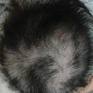 Asymptomatic hair loss