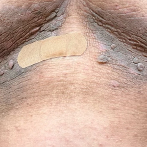 Hyperpigmented flexural plaques, hypohidrosis, and hypotrichosis