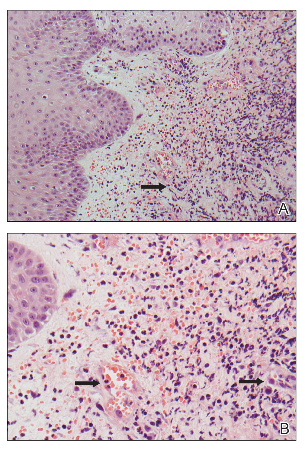 A, Histopathology showed neutrophilic inflammation around smaller capillary-sized vessels (H&E, original magnification ×200). A central small vessel (arrow) was completely obliterated by neutrophils and rimmed by leukocytoclastic debris