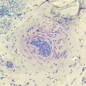 Frozen sections of a basal cell carcinoma (original magnification ×100 for both). 