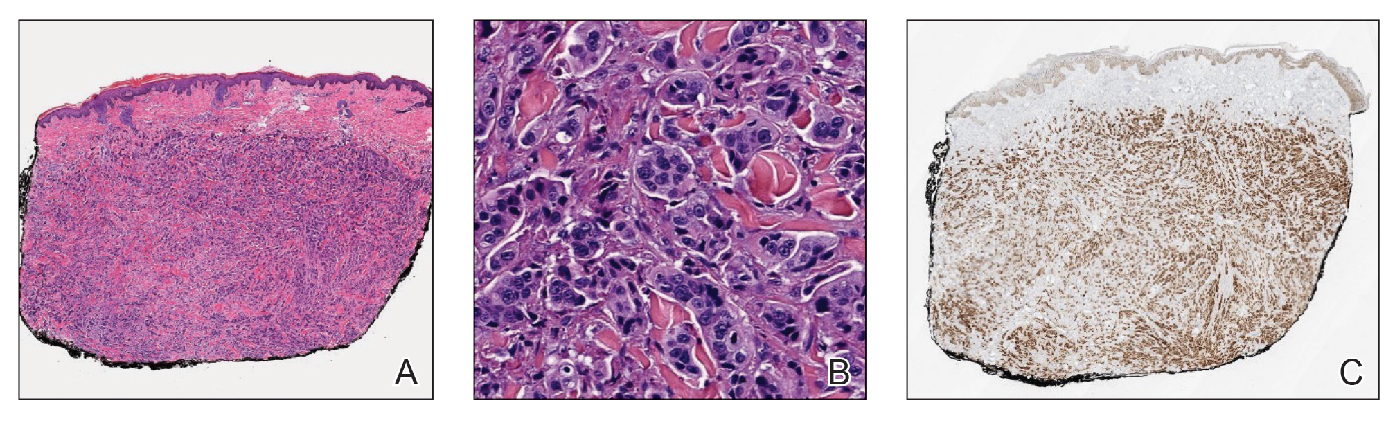 A, Histopathology demonstrated a dermal cellular infiltrate arranged in cords that dissected through the sclerotic collagen bundles (H&E, original magnification ×40). B, Cells were epithelioid with large vesicular nuclei and prominent nucleoli to cuboid