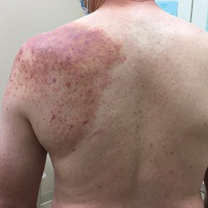 Reactive angioendotheliomatosis with palpable purpura in a dermatomal distribution with nonpitting edema over the left scapula