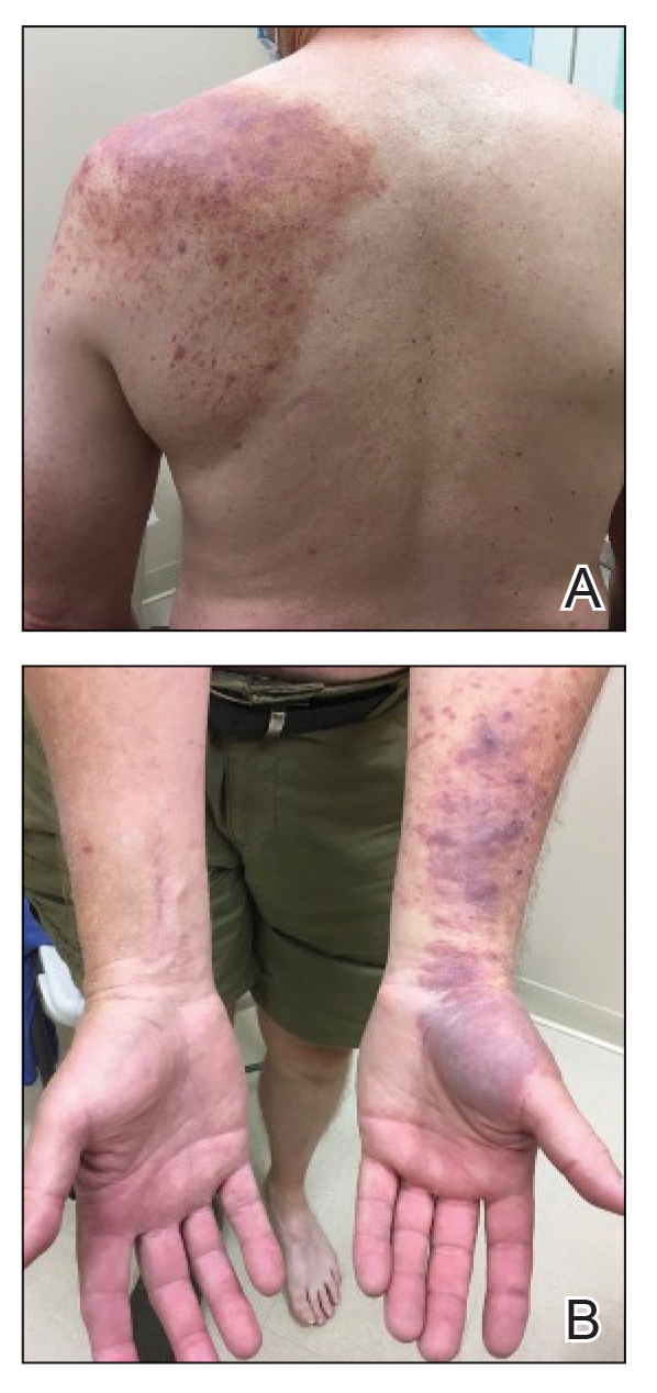 A, Reactive angioendotheliomatosis with palpable purpura in a dermatomal distribution with nonpitting edema over the left scapula. B, Similar findings were seen on the thenar eminence of the left hand and left lateral volar forearm.