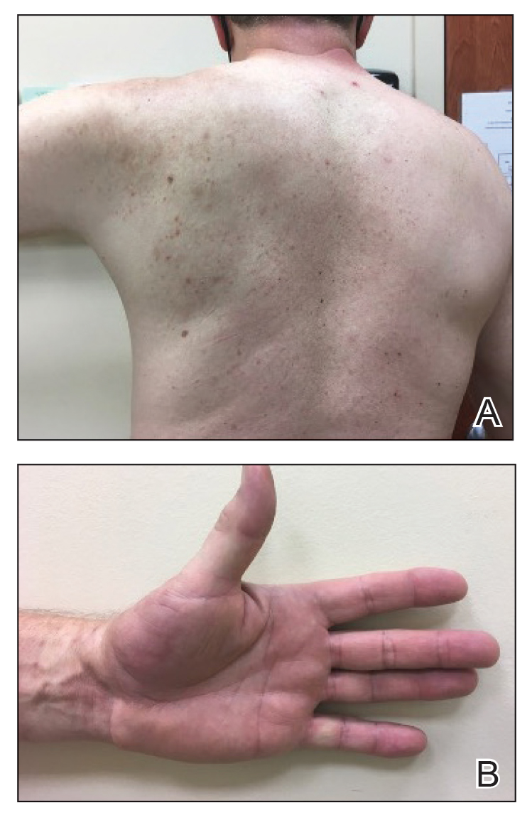 At 3-month follow-up, reactive angioendotheliomatosis on the left scapula and left thenar eminence, respectively, had completely resolved after treatment with triamcinolone ointment 0.1% and oral cetirizine.