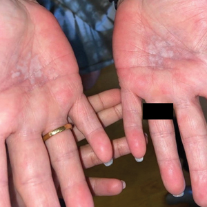 Bilateral burning palmoplantar lesions