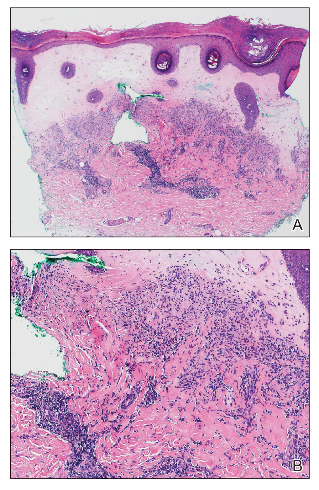 Histopathology revealed a thin epidermis with homogenization of upper dermal collagen and a sclerotic dermis with a patchy chronic dermal infiltrate (H&E, original magnifications ×40 and ×100).