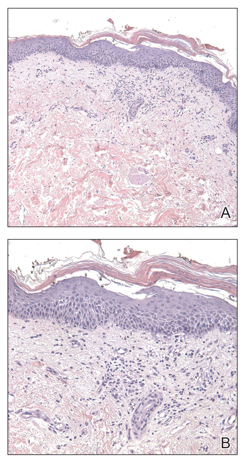 A biopsy specimen of the left axilla demonstrated a mild lichenoid and perivascular lymphocytic infiltrate containing scattered eosinophils, neutrophils, and a few extravasated erythrocytes.