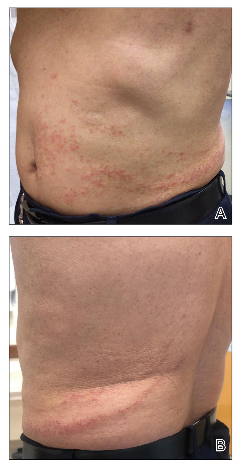 At a 3-month follow-up visit, erythematous macules and papules coalesced over a salmon-colored base along the lines of Blaschko extending from the left lower abdominal quadrant, crossing the left flank, and continuing to the left lower back without crossi