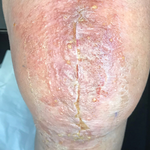 A vesicular eruption with crusting around a postoperative total knee arthroplasty incision site due to cyanoacrylate-based surgical glue.