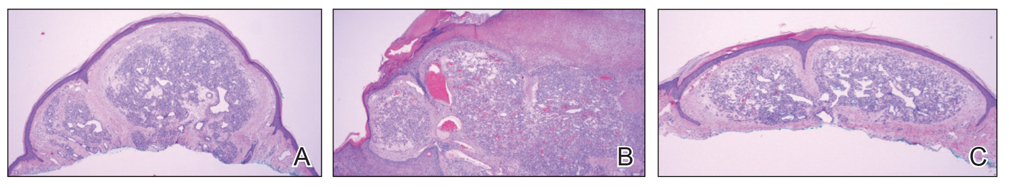 Histopathology from the left cheek, medial breast, and medial superior chest demonstrated lobular aggregates of small-caliber vessels set in an edematous inflamed stroma and partially enclosed by small collarettes of adnexal epithelium