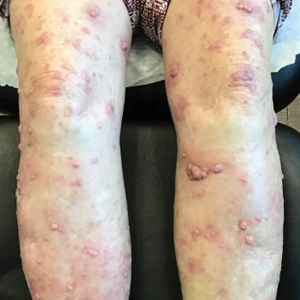 Clinical presentation of well-differentiated cutaneous squamous cell carcinoma, keratoacanthoma type, on the arms and legs, respectively, with widespread red, tender, scaly papules and nodules.