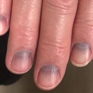 Blue to slate gray discoloration of the proximal fingernails