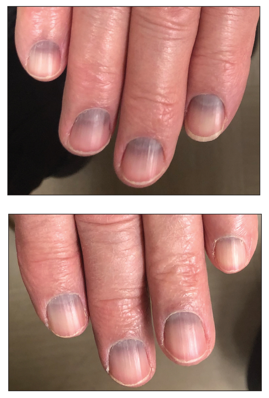 Caratin Rx Blog: Green Nail Syndrome: What Is It And How To Cure It