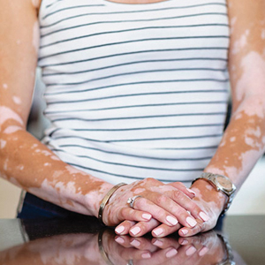 Vitiligo