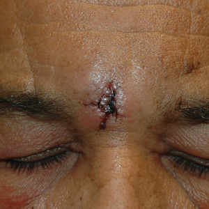  Anterior view of the wound from the removal of a vascular anomaly of the glabella at 1-week postoperative follow-up.