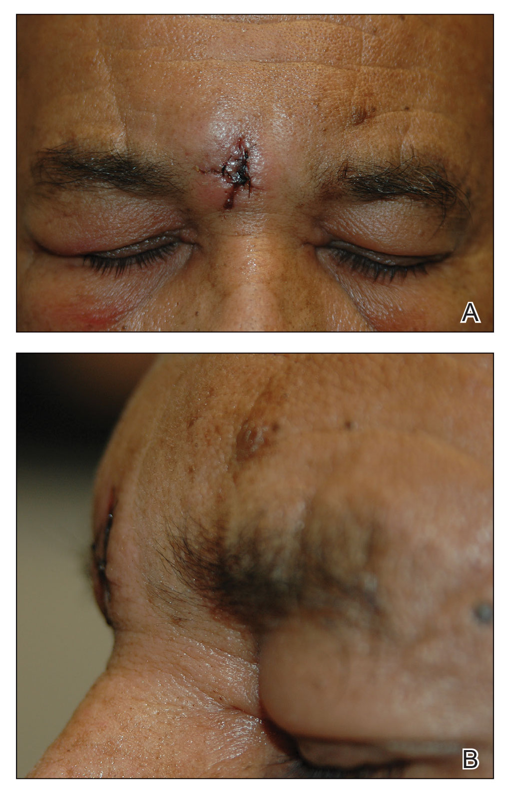 Anterior and lateral views of the wound from the removal of a vascular anomaly of the glabella at 1-week postoperative follow-up.