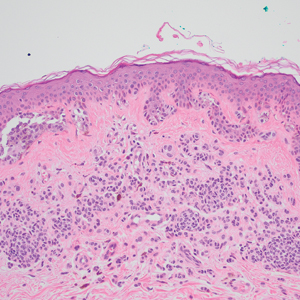 Special-site nevus histopathology showing a compound nevus with mild melanocyte cytologic atypia and architectural distortion at center of lesion