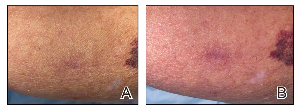 A, An ill-defined biopsy scar on the upper arm. B, Rubbing it with an alcohol swab showed blushing, which facilitated accurate identification via dermoscopy or plain visualization. 