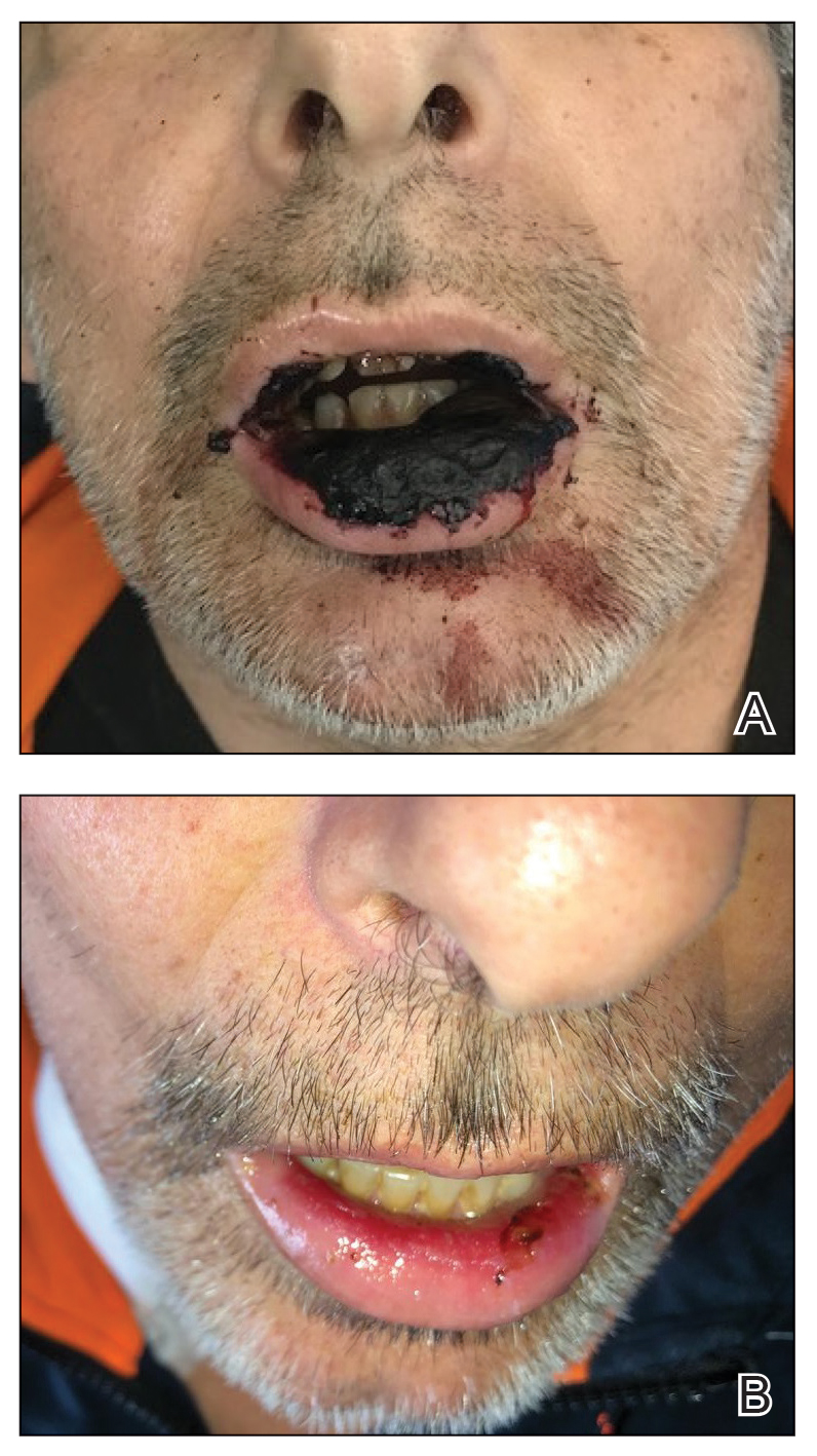 A, The patient presented with massive necrosis of the lower lip as well as partial necrosis of the upper lip (not shown). B, Mucositis resolved 4 days after discontinuation of methotrexate therapy and initiation of leucovorin rescue therapy.