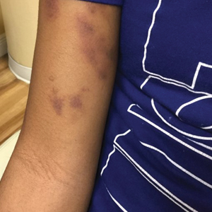 Hyperpigmented patches distributed along the right ventral arm, which were diagnosed as psychogenic purpura.