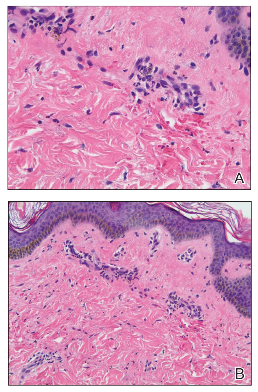 A punch biopsy of the upper arm demonstrated a mild superficial perivascular dermal mixed infiltrate associated with extravasated erythrocytes (H&E, original magnifications ×200 and ×400). 