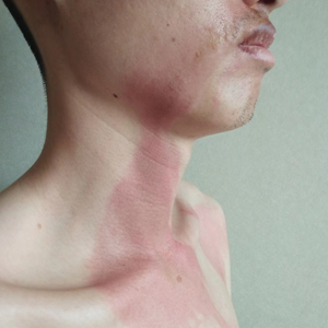 Burning skin patches on the face, neck, and chest