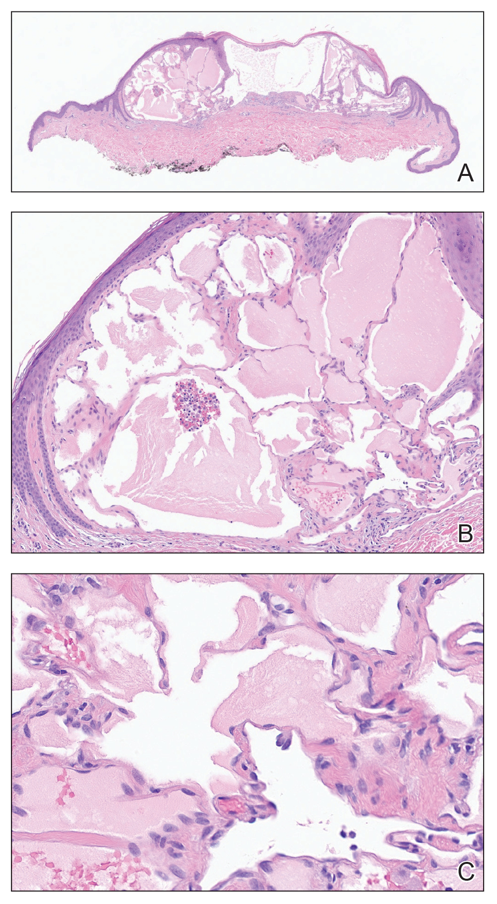 Histopathology showed a vascular proliferation limited to the papillary dermis with dilated lymphatic spaces lined by a single layer of cytologically bland endothelial cells consistent with acquired cutaneous lymphangiectasia