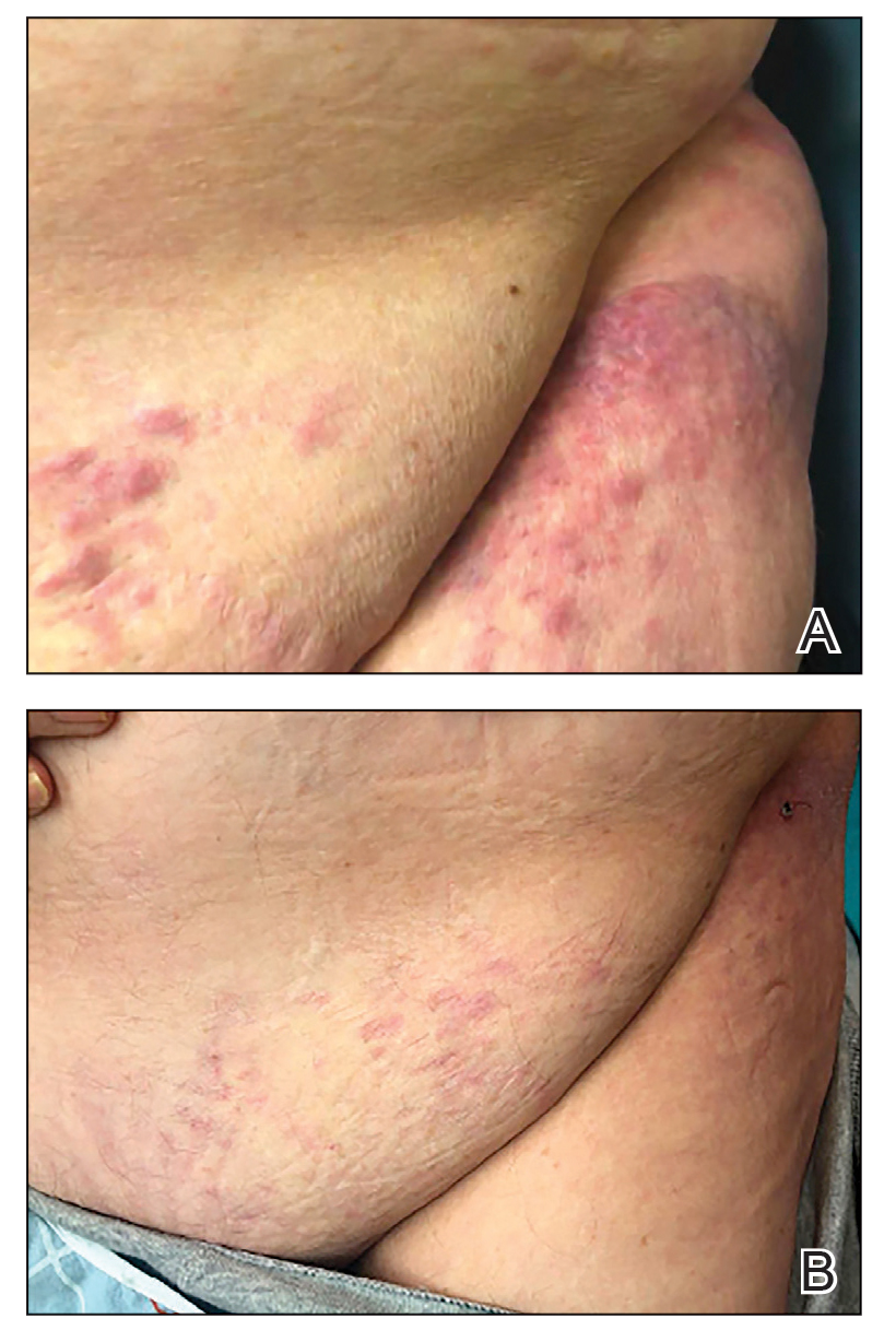 A, Erythematous and violaceous indurated nodules and plaques on the left lower abdomen and left hip that were later diagnosed as cutaneous Burkitt lymphoma.