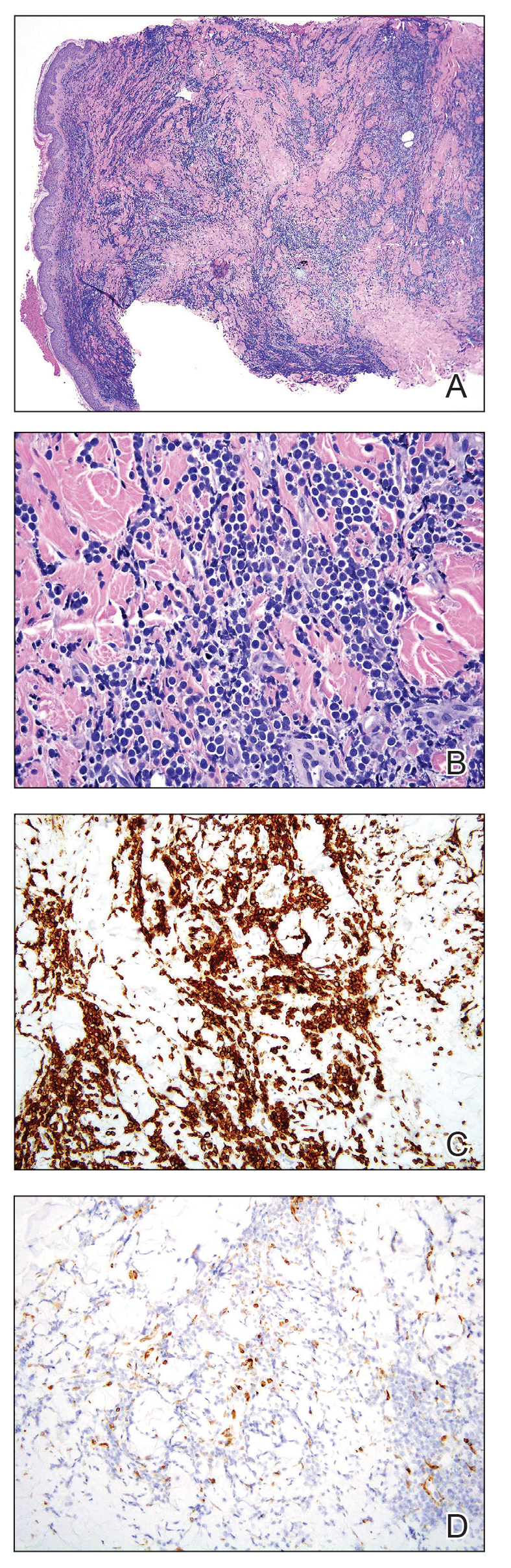 A punch biopsy specimen showed markedly atypical lymphocytes present throughout the dermis